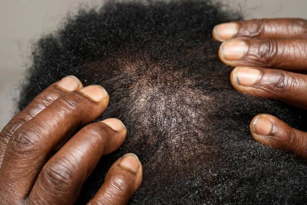 Alopecias